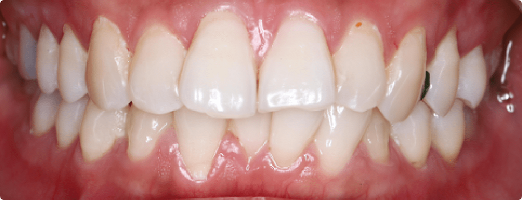 歯周病の入り口